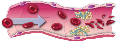 Coagulo di sangue nella TTP